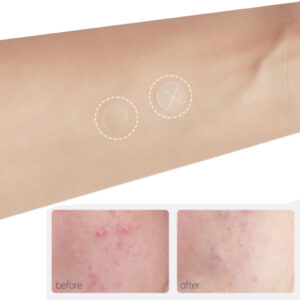 Invisible Salicylic Acid Acne Cover Patches - 72PCS Hide and heal pimples