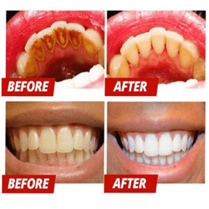 Teeth Whitening Essence 21952
