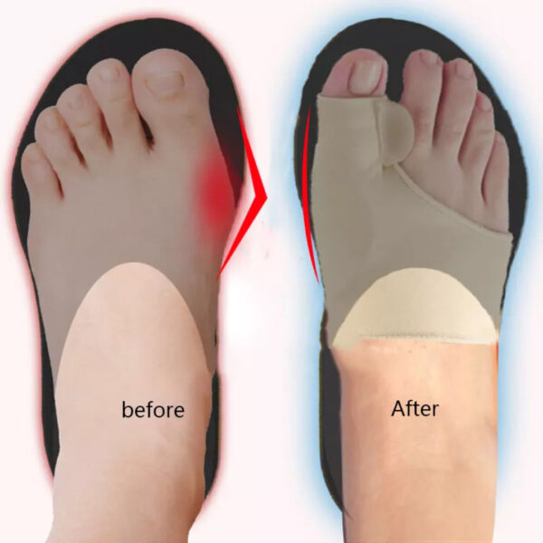Big Toe Straightener 20774