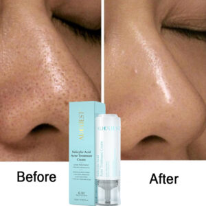 Salicylic Acid Acne Cream 20128
