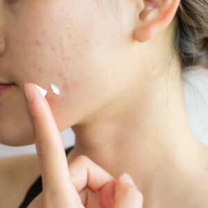 Salicylic Acid Acne Cream 20128