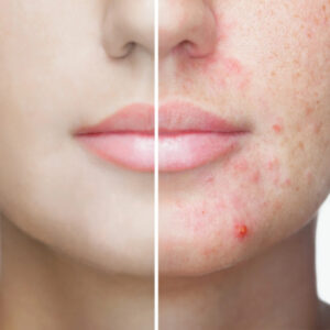Salicylic Acid Acne Cream 20128