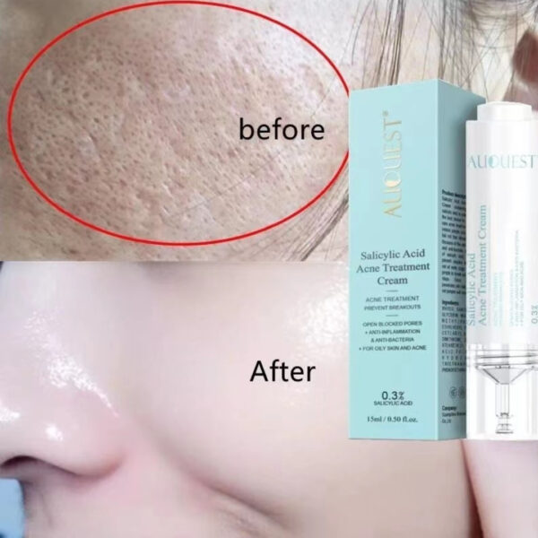 Salicylic Acid Acne Cream 20128