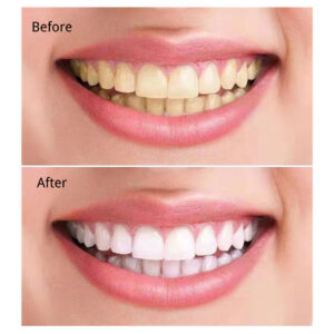 pearl teeth whitening powder 20410