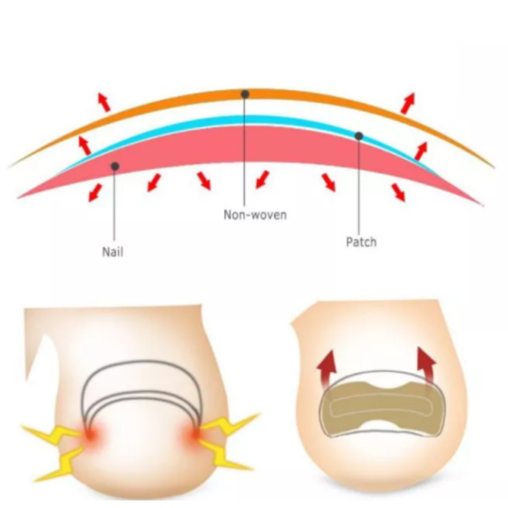 Ingrown toenails patch 20782 (4)
