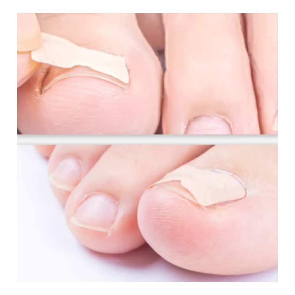 Ingrown toenails patch 20782 (6)