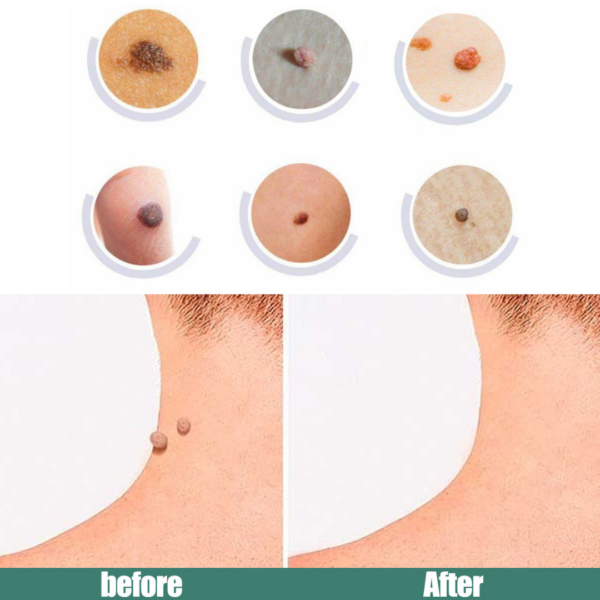 Medical gel to remove warts 20405