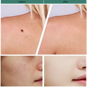Medical gel to remove warts 20405