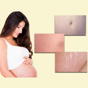 Stretch mark repair 31813
