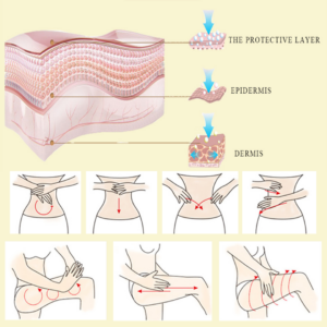 Stretch mark repair 31813