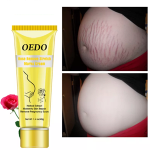 Stretch mark repair 31813