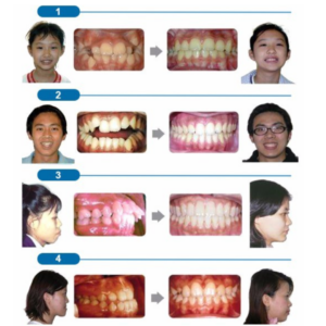 dental braces for crooked teeth 31316 (15)