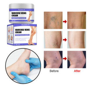 varicose veins cream 20176
