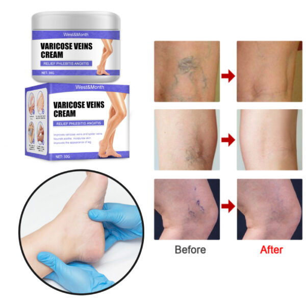 varicose veins cream 20176
