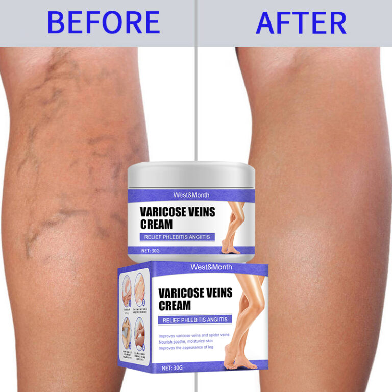 varicose veins cream 20176