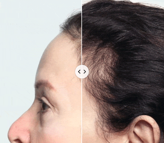 DERMA ROLLER - משקם ומאיץ את צמיחת שיער